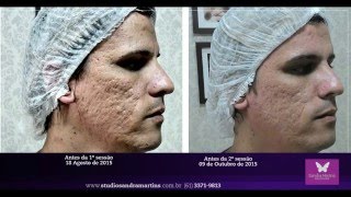 Microagulhamento rejuvenescimento clareamento e cicatriz de acne [upl. by Yrtua]