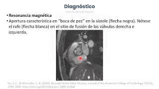 Válvula Aórtica Bivalva Cardiología [upl. by Uhayile]