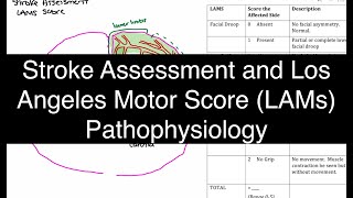 Stroke Assessment and Los Angeles Motor Score LAMS Pathophysiology [upl. by Ecirp]