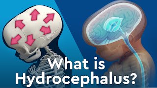 What is Hydrocephalus and Why Does Fluid Build Up in the Brain [upl. by Tabina]