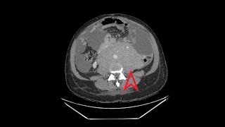 Chest Abdomen Pelvis CT Large Abdominal Mass [upl. by Tyra]