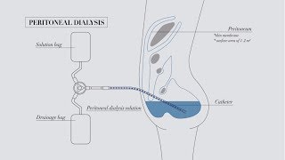 Understanding peritoneal dialysis [upl. by Irrep271]