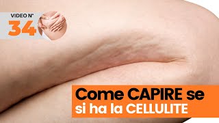 Come capire se si ha la cellulite [upl. by Acirea295]