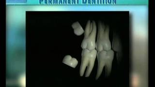 Clip 20 Eruption of Third Molars [upl. by Didi]