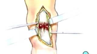 PreOp® Patient Education Achilles Tendon Repair Surgery 3 [upl. by Orthman]