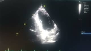 akinetic septum hypokinetic mid apical anterior and inferior wall moderate Lv [upl. by Bussey]