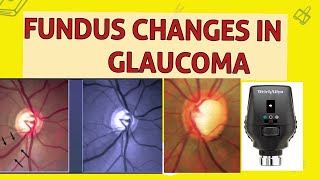 OPTIC DISC CHANGES IN GLAUCOMA [upl. by Llecrep]