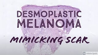 Desmoplastic melanoma mimicking scar Clue pink collagen replacing blue solar elastosis [upl. by Aneetak]