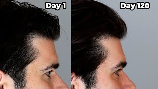 I put ROSEMARY OIL in My HAIR Everyday  120 Day Results [upl. by Blainey]