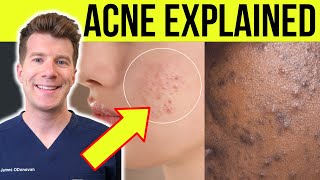 Doctor explains ACNE  Causes symptoms treatment and more [upl. by Ashjian]