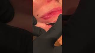 FACE BLACKHEADS [upl. by Hasan]