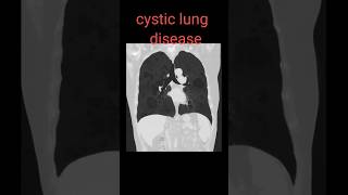 cystic lung disease shorts radiology lungsdisease radiologyjunction [upl. by Attelrac643]