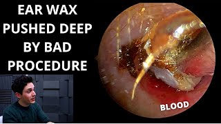 Ear Wax Pushed Down By Negligent Procedure Ear ImpressionsMouldings [upl. by Acassej]