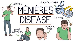 Understanding Ménière’s Disease [upl. by Galan]