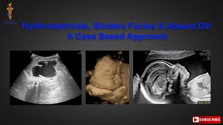 Hydronephrosis Binders Facies and Absent DV A Case Based Approach [upl. by Mcgruter]