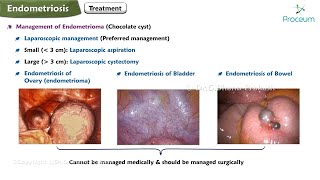 Endometriosis Etiology Pathology Clinical features Investigations Treatment [upl. by Pontias]