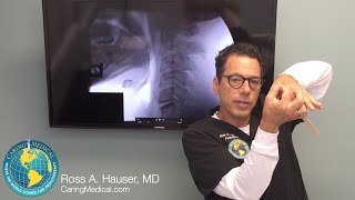 Neck pain after C5C6 disc replacement surgery  DMX review with Ross Hauser MD [upl. by Lisha]