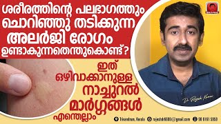 ശരീരത്തിൽ ചൊറിഞ്ഞു തടിക്കുന്ന അലർജി ഉണ്ടാകുന്നതെങ്ങനെ ചൊറിച്ചിലും അലർജിയ്ക്കും നാച്ചുറൽ മാർഗ്ഗങ്ങൾ [upl. by Acihsay]