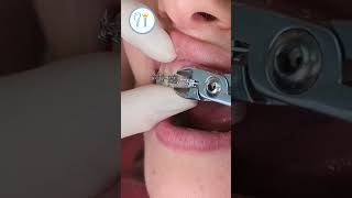 Braces Removal after orthodontic treatment braces bracesoff bracesadjustment [upl. by Day5]