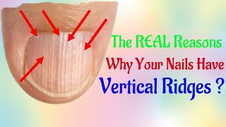 The REAL Reasons Why Your Nails Have Vertical How to Treat and Fix Vertical Ridges [upl. by Barram871]