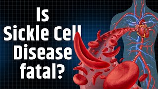 Why is it important to understand Sickle Cell Disease [upl. by Yclek]