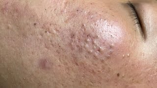 ACNE TREATMENT VU QUYNH MI  Blackheads On Boy Chin 2024FULL [upl. by Nauh]