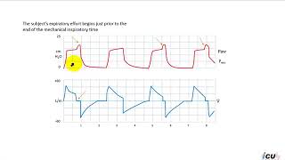 Termination Asynchrony on Mechanical Ventilation [upl. by Jairia402]