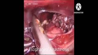 Thoracoscopic repair of Esophageal atresia with tracheoesophageal fistula [upl. by Maer776]