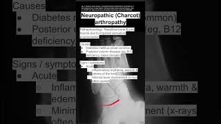 Neuropathic Charcot arthropathy [upl. by Ruffi581]