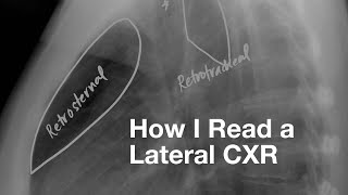 How I Read a Lateral CXR [upl. by Adekram199]