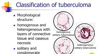 Secondary tuberculosis Focal tuberculosis Tuberculoma Infiltrative tuberculosis [upl. by Etnohc]