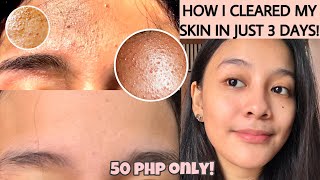 HOW TO GET RID OF TINY BUMPS ON FOREHEADFACE FAST  FUNGAL ACNE how i cleared my skin ENG SUB [upl. by Alley]