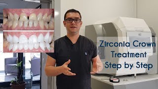 Zirconia Crown Treatment in Turkey amp How We Produce Zirconia Crowns in Elit Dental Clinic Kusadasi [upl. by Eilyak]