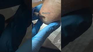 Painful Heel Porokeratosis Removal [upl. by Falzetta341]