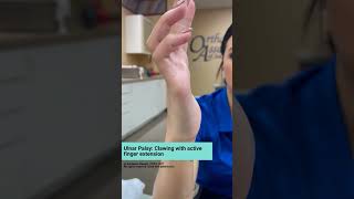 Example of ulnar palsy patient with a claw deformity with PIP joint contracture [upl. by Anner443]