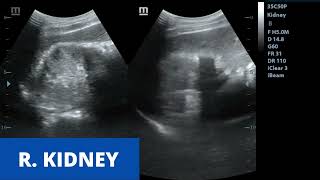 Acute Pyelonephritis  Ultrasound Case [upl. by Suhsoj]