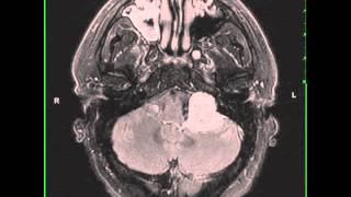 Jugular Foramen Schwannoma left [upl. by Schuster341]