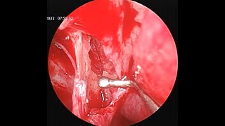 ESPAL  Endoscopic Sphenopalatine Artery Ligation  Cautery [upl. by Juliane68]