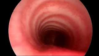 Normal Airway Endoscopy Examination  Paediatric ENT Consultant London  ENT Surgery London [upl. by Adnirb74]