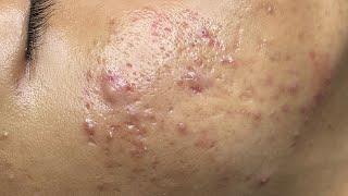 ACNE TREATMENT VU QUYNH MI Acne On Boys Chin 2024 [upl. by Felipa]