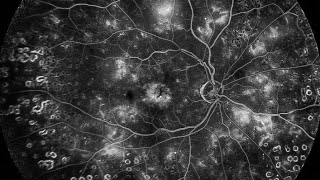 Fundus Fluorescein Angiography FFA Detail explanation [upl. by Velda268]