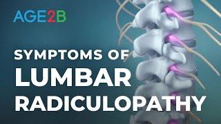 What Are the Symptoms of Lumbar Radiculopathy  Spinal Nerve Root Pain  Disc Bulge [upl. by Hajar]