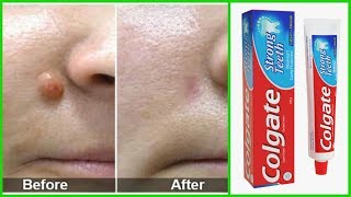 Remove Skin Tag In 1 Night By Applying Toothpaste  SC [upl. by Nitsirt]