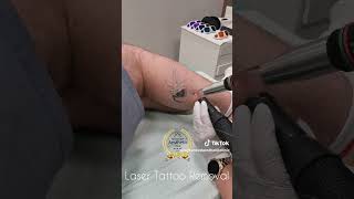 Spider Laser Tattoo removal advancedaestheticclinic tattooremoval [upl. by Leonore577]