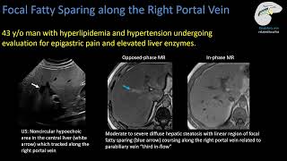 Hepatic Steatosis Part 3 Mimics and Pitfalls [upl. by Abas]