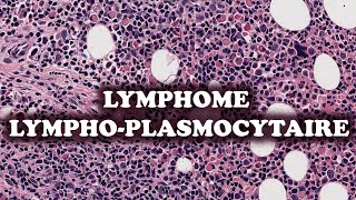 LE LYMPHOME LYMPHOPLASMOCYTAIRE  PATHOLOGIE [upl. by Hylan95]