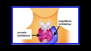 Hyperthyreose bei Frauen Symptome und empfohlene Nahrungsmittel [upl. by Cynde]