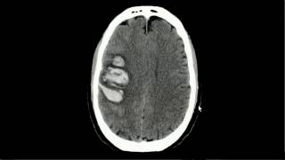 Trombose de veia cerebral superficial [upl. by Jessy874]