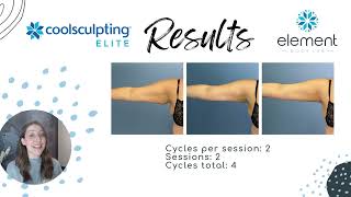 CoolSculpting Elite Upper Arm Before amp After Results  Element Body Lab  Dallas Tx [upl. by Aiek]