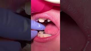 Invisalign Time Lapse  Invisalign Braces  Invisalign Before After invisalignsmile clearaligner [upl. by Mihe789]